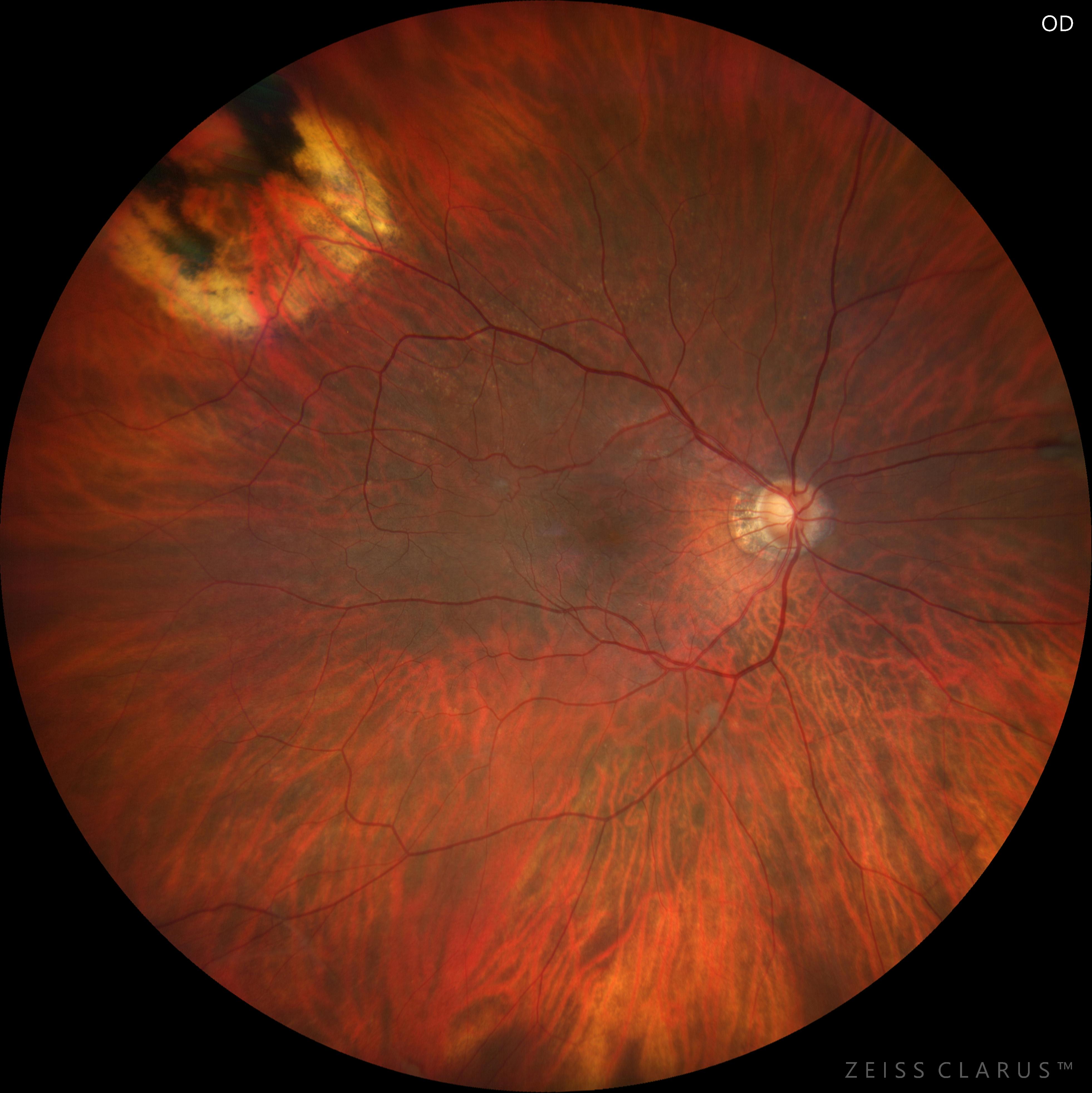 Management of Chronic Postoperative CME With Uveitis Retina Today